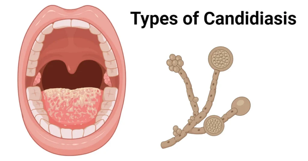 disseminated candidiasis