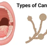 disseminated candidiasis