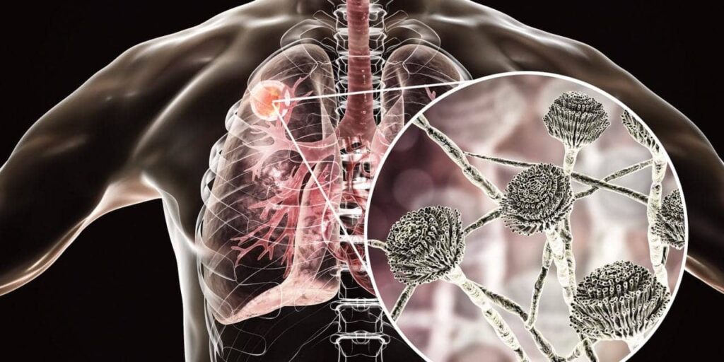 disseminated coccidioidomycosis