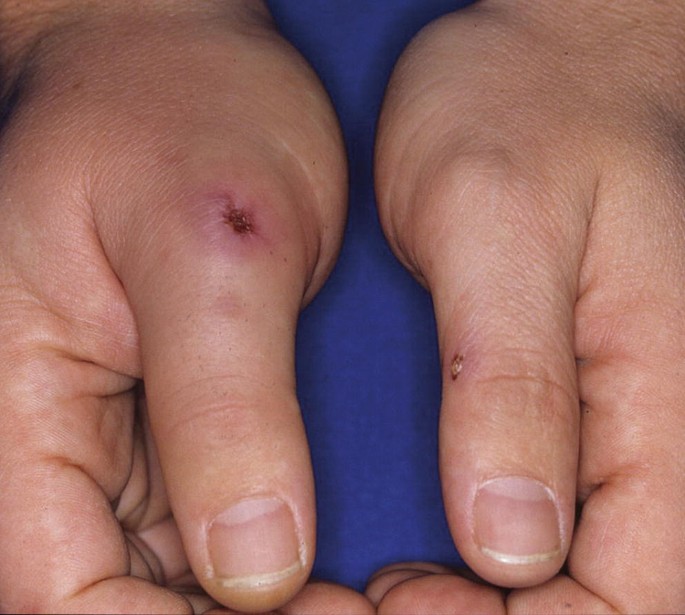 disseminated gonococcal infection