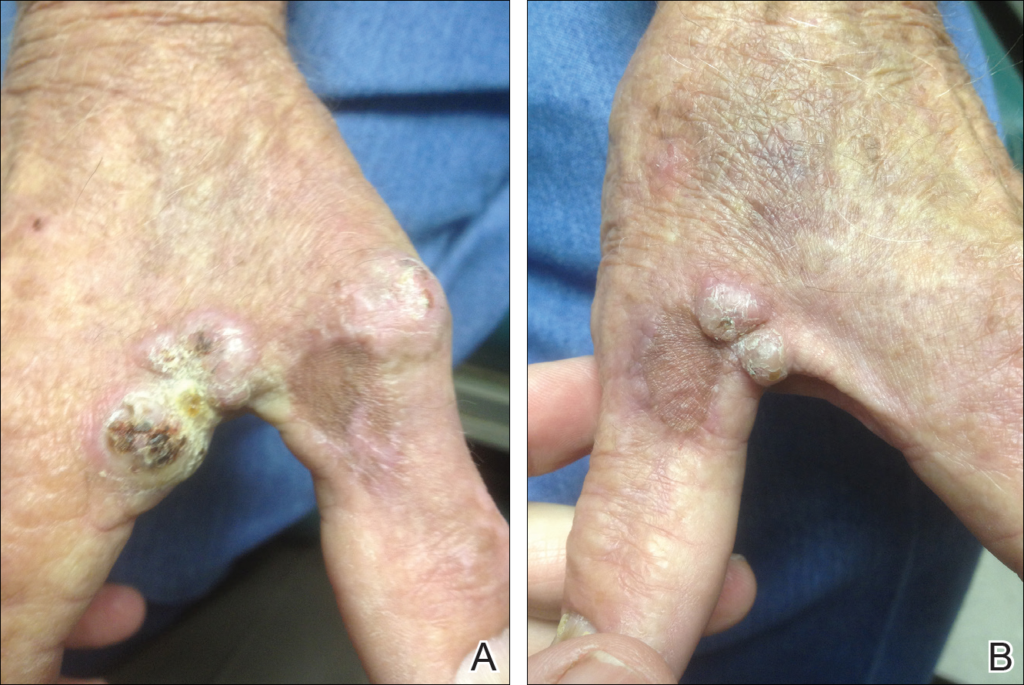 disseminated mycobacterium avium complex infection