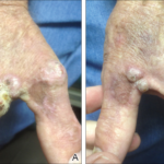 disseminated mycobacterium avium complex infection