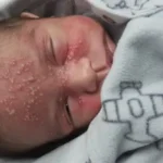 disseminated neonatal herpes simplex infection