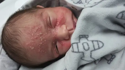 disseminated neonatal herpes simplex infection