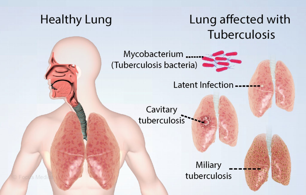 disseminated tuberculosis