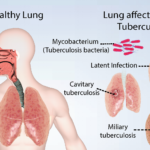 disseminated tuberculosis