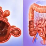 diverticulitis of gastrointestinal tract