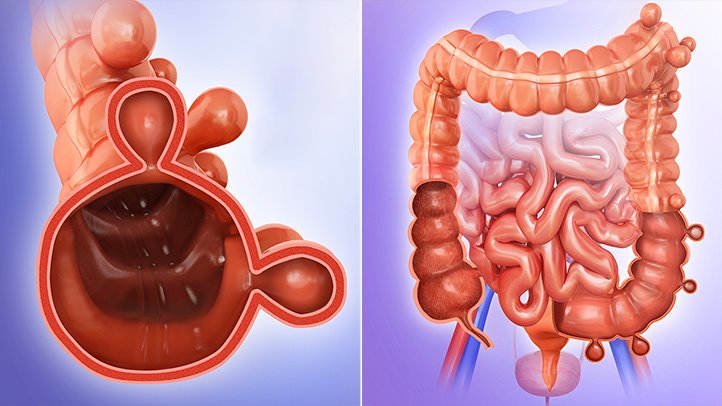 diverticulitis of gastrointestinal tract