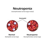 Drug-induced neutropenia is a hematologic disorder characterized by an abnormally low neutrophil count, increasing susceptibility to infections. This condition arises as an adverse reaction to various medications, ranging from chemotherapy agents to non-chemotherapy drugs such as antibiotics, antipsychotics, and antithyroid medications. Given the potential severity of this condition, early detection and intervention are crucial for preventing life-threatening complications. Mechanisms of Drug-Induced Neutropenia The development of drug-induced neutropenia occurs through two primary mechanisms: Decreased Neutrophil Production Some drugs exert direct toxicity on bone marrow progenitor cells, impairing their ability to produce neutrophils. This suppression can occur due to inhibition of myeloid cell differentiation, cytotoxic effects on stem cells, or disruption of hematopoietic growth factors. Medications such as antithyroid drugs and chemotherapy agents are known to interfere with neutrophil production. Increased Neutrophil Destruction Certain medications trigger immune-mediated destruction of neutrophils. This process occurs when drug-related metabolites act as haptens, forming neoantigens that stimulate the immune system to produce anti-neutrophil antibodies. The result is accelerated clearance of neutrophils, leading to profound neutropenia. High-Risk Medications Several drug classes have been implicated in drug-induced neutropenia, with varying degrees of risk: Antithyroid Drugs Propylthiouracil Methimazole These drugs are commonly associated with bone marrow suppression, necessitating regular monitoring of blood counts. Antipsychotics Clozapine Clozapine-induced agranulocytosis is a well-documented adverse reaction, requiring strict hematologic monitoring. Antibiotics Beta-lactams (e.g., penicillins, cephalosporins) Sulfonamides Certain antibiotics can trigger neutropenia via immune-mediated destruction or direct marrow suppression. Antiplatelet Agents Ticlopidine This medication, once widely used, has been largely replaced by alternatives with better safety profiles due to its risk of severe neutropenia. Clinical Manifestations The severity of symptoms depends on the depth and duration of neutropenia: Early Symptoms Fever Chills Sore throat Malaise These nonspecific symptoms often precede more serious complications. Severe Infections Pneumonia Septicemia Mucosal ulcers Sepsis and septic shock Profound neutropenia impairs immune function, increasing the risk of life-threatening infections. Diagnostic Approaches Laboratory Investigations Complete Blood Count (CBC): Confirms neutropenia. Absolute Neutrophil Count (ANC):