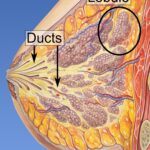 ductal carcinoma in situ of breast