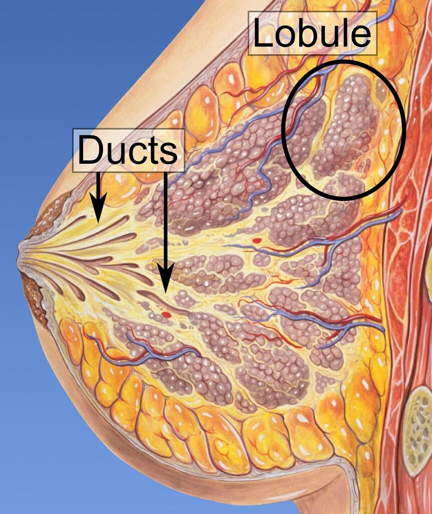 ductal carcinoma in situ of breast