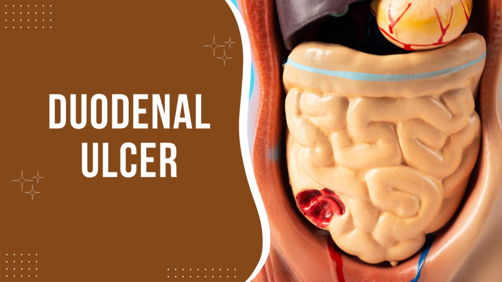 duodenal ulcer