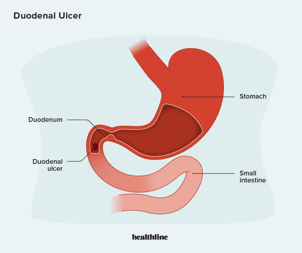 duodenal ulcer