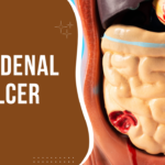 duodenal ulcer