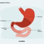 duodenal ulcer