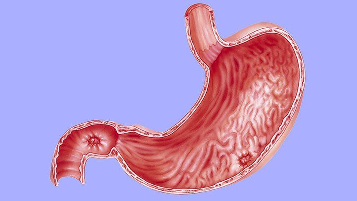 duodenal ulcer due to h. pylori