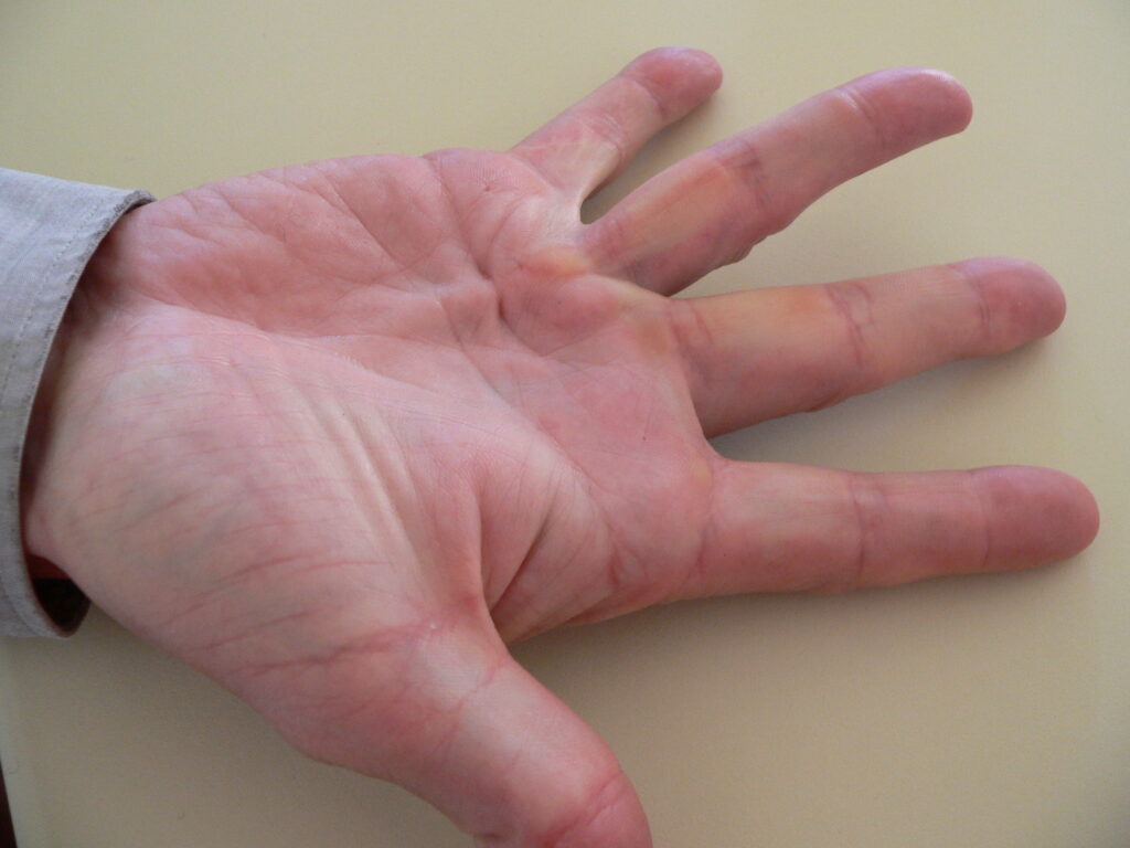 dupuytren's contracture