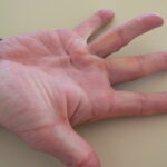 dupuytren's contracture