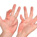 dupuytren's contracture