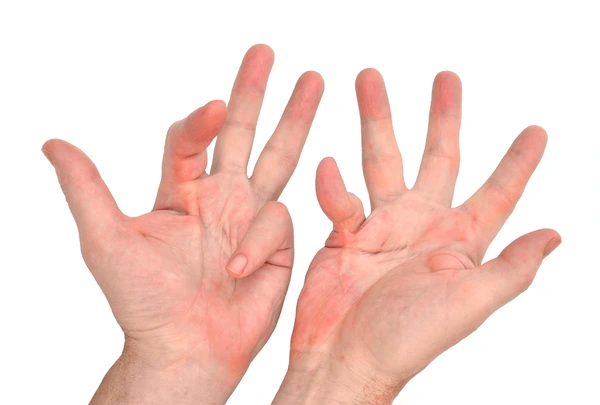 dupuytren's contracture