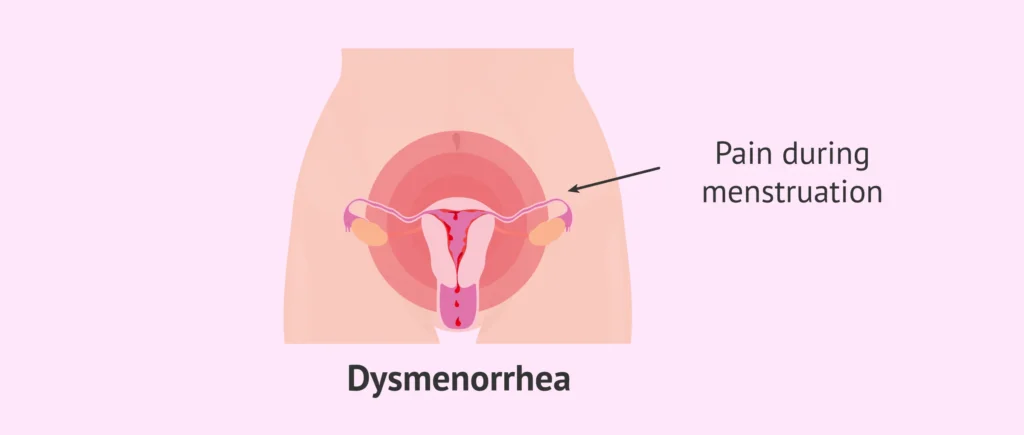 dysmenorrhea