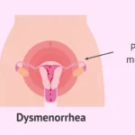 dysmenorrhea