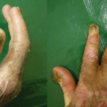 dystrophic epidermolysis bullosa