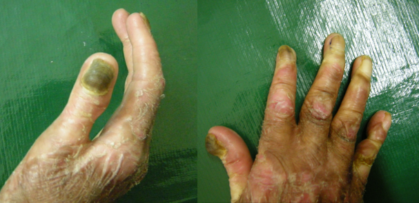 dystrophic epidermolysis bullosa