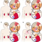 ectopic acth syndrome