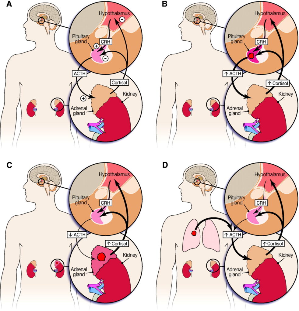 ectopic acth syndrome