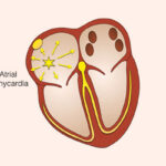 ectopic atrial tachycardia