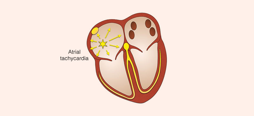 ectopic atrial tachycardia