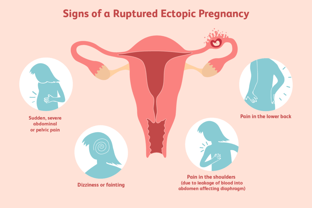 ectopic pregnancy