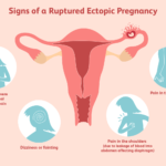 ectopic pregnancy