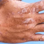 eczema