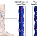 edema due to chronic venous insufficiency