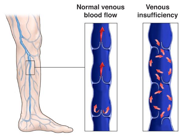 edema due to chronic venous insufficiency