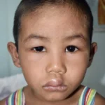 edema due to nephrotic syndrome