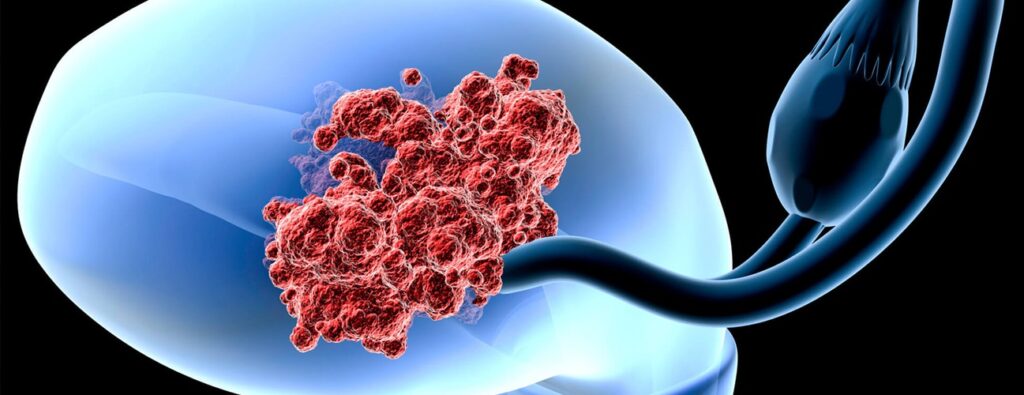 endometrial carcinoma