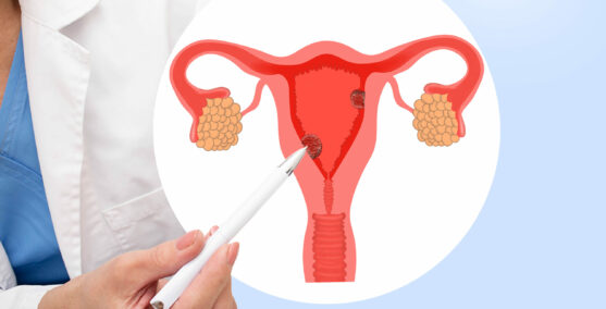 endometrial carcinoma adjunct treatment