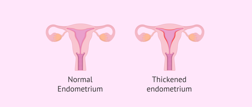 endometrial hyperplasia prevention