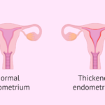 endometrial hyperplasia prevention