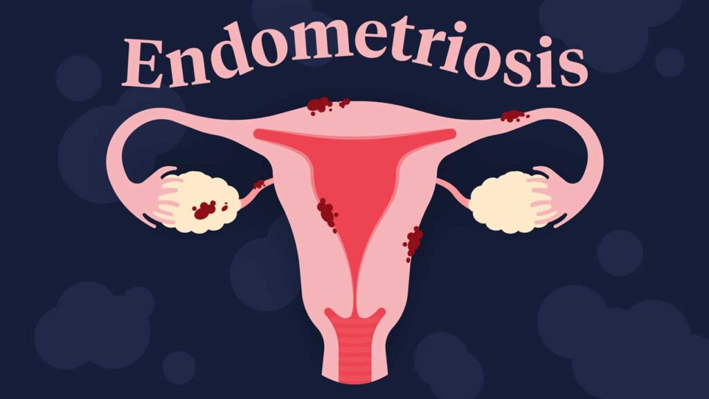 endometriosis