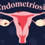 endometriosis