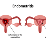 endometritis