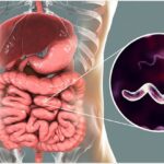 enteric campylobacteriosis