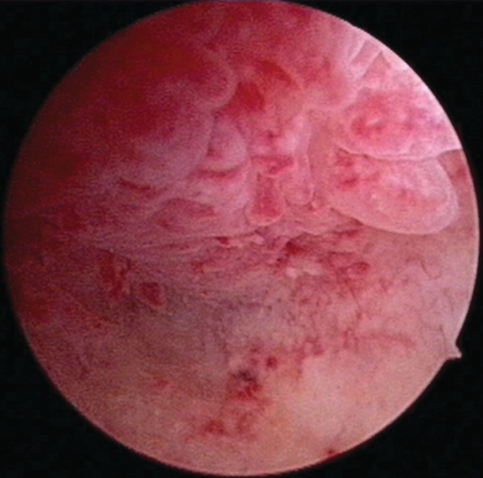 enterobacter endometritis