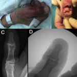 enterobacter joint infection