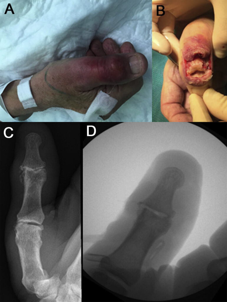 enterobacter joint infection