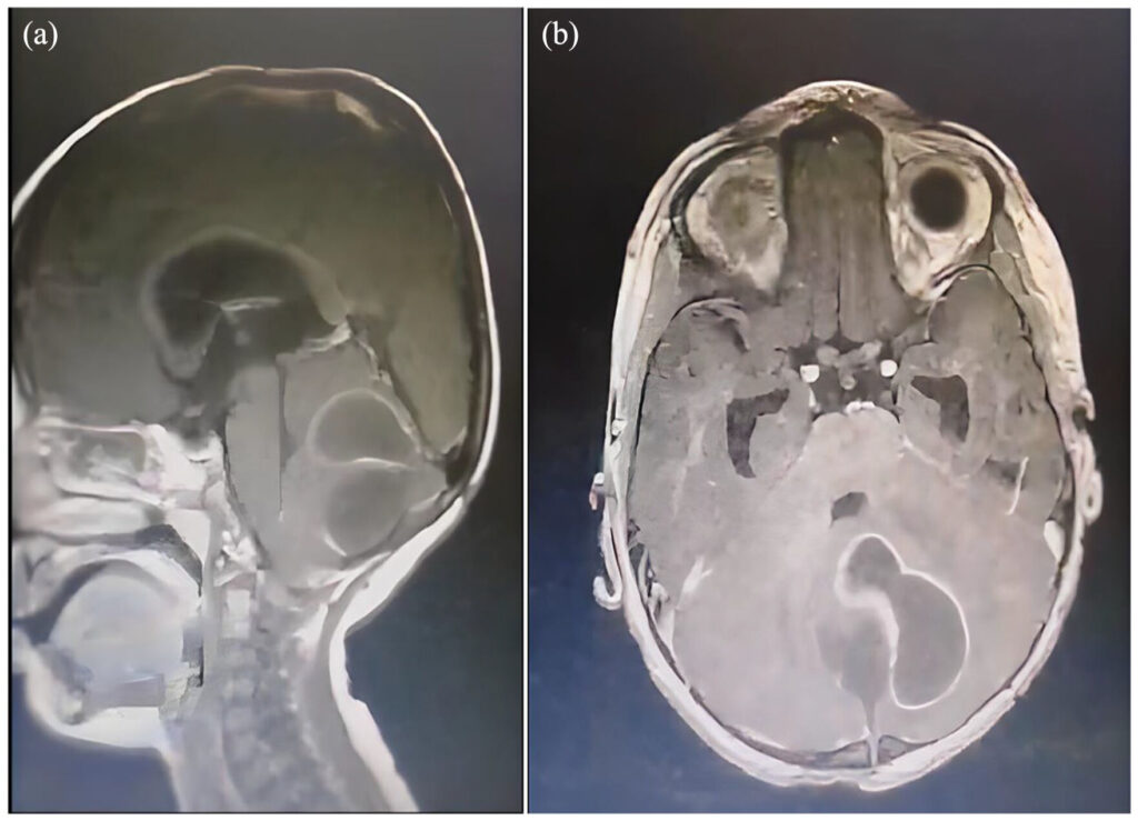 enterobacter meningitis